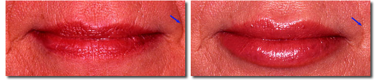 Fat Injection Pictures