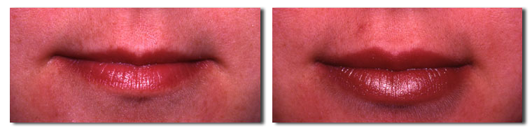 Fat Injection Pictures